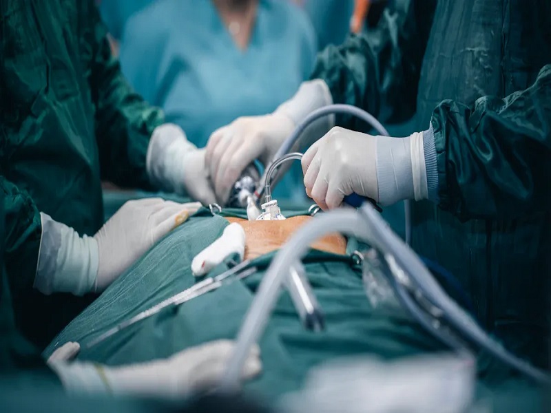 Understanding Laparoscopic Surgical Staplers for Modern Minimally Invasive Surgery